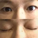 下まぶたたるみ取り セオリークリニック DAY 30 サムネイル用