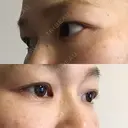 下まぶたたるみ取り セオリークリニック DAY 30 サムネイル用