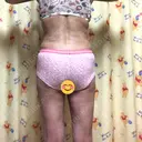 脂肪吸引（二の腕） / 脂肪吸引（脚） / 脂肪吸引（お尻） / その他（ボディ） 湘南美容クリニック 大阪梅田本院 DAY 62 サムネイル用