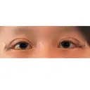 目尻切開 / 目尻靭帯移動 VARABON美容外科 DAY 1 サムネイル用