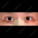 目尻切開 / 目尻靭帯移動 VARABON美容外科 DAY 4 サムネイル用