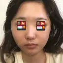 骨削り（頬） RG整形外科（旧リオン整形外科） DAY -391 サムネイル用