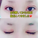 二重切開 GLANZ CLINIC DAY 9 サムネイル用