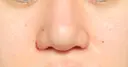 鼻尖形成（切開） / 小鼻縮小（切開） / ヒアルロン酸注入（鼻） 東京ヒルズクリニック 新宿院 DAY 6 サムネイル用