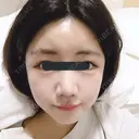 骨切り（あご） / 骨削り（エラ） / 骨削り（頬） / 脂肪吸引（顔） / 脂肪注入（額） / 脂肪溶解注射（顔） View美容整形外科 AFTER サムネイル用
