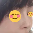 隆鼻術 / 鼻中隔延長（切開） View美容整形外科 DAY 207 サムネイル用