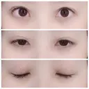 二重埋没 / 眼瞼下垂（切開） / クマ治療 / 下まぶたの脂肪取り THE MEDICAL SALON DAY 62 サムネイル用