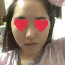 骨削り（頬） RG整形外科（旧リオン整形外科） DAY -388 サムネイル用