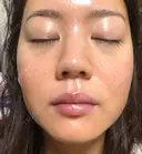 ニキビ治療 たにまちクリニック DAY 183 サムネイル用