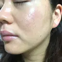 ニキビ治療 たにまちクリニック DAY 183 サムネイル用
