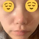 鼻尖形成（切開） / 鼻中隔延長（切開） / 小鼻縮小（切開） / 軟骨移植 HANABI整形外科 DAY 83 サムネイル用