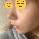 鼻尖形成（切開） / 鼻中隔延長（切開） / 小鼻縮小（切開） / 軟骨移植 HANABI整形外科 DAY 83 サムネイル用