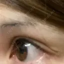 二重切開 牧野皮膚科形成外科内科医院 美容外科・形成外科・抗加齢医学外来 DAY 402 サムネイル用