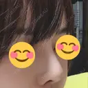 隆鼻術 / 鼻中隔延長（切開） View美容整形外科 DAY 210 サムネイル用