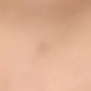 ほくろ・いぼ切除（肌） 大山皮膚科 AFTER サムネイル用