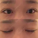 二重埋没 湘南美容クリニック 福島院 DAY 10 サムネイル用