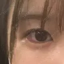 ヒアルロン酸注入（涙袋） the way（ザウェイ）整形外科 DAY 0 サムネイル用