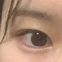 ヒアルロン酸注入（涙袋） the way（ザウェイ）整形外科 DAY 1 サムネイル用