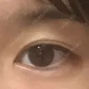 ヒアルロン酸注入（涙袋） the way（ザウェイ）整形外科 DAY 1 サムネイル用