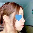 鼻中隔延長（切開） / 軟骨移植 / 鼻尖縮小 HANABI整形外科 AFTER サムネイル用