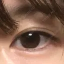 ヒアルロン酸注入（涙袋） the way（ザウェイ）整形外科 DAY 2 サムネイル用