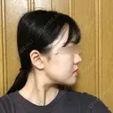 骨切り（あご） / 骨削り（エラ） / 骨削り（頬） RG整形外科（旧リオン整形外科） DAY 61 サムネイル用