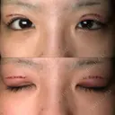 二重切開 / 上まぶたの脂肪取り TCB東京中央美容外科 江坂院 DAY 0 サムネイル用