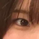 ヒアルロン酸注入（涙袋） the way（ザウェイ）整形外科 DAY 3 サムネイル用