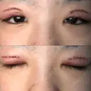 二重切開 / 上まぶたの脂肪取り TCB東京中央美容外科 江坂院 DAY 1 サムネイル用