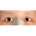 目尻切開 / 目尻靭帯移動 VARABON美容外科 DAY 7 サムネイル用