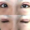 二重切開 / 上まぶたの脂肪取り TCB東京中央美容外科 江坂院 DAY 2 サムネイル用