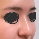 その他（鼻） / 糸リフト / 鼻修正 / ヒアルロン酸注入（額） Beauty Clinic the GINZA DAY 19 サムネイル用