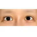 目尻切開 / 目尻靭帯移動 VARABON美容外科 DAY 35 サムネイル用