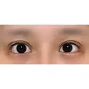 目尻切開 / 目尻靭帯移動 VARABON美容外科 AFTER サムネイル用