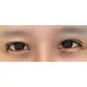 目尻切開 / 目尻靭帯移動 VARABON美容外科 DAY 64 サムネイル用