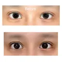 目尻切開 / 目尻靭帯移動 VARABON美容外科 DAY 64 サムネイル用