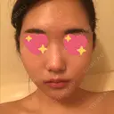 骨削り（頬） RG整形外科（旧リオン整形外科） DAY -380 サムネイル用