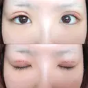 二重切開 / 上まぶたの脂肪取り TCB東京中央美容外科 江坂院 DAY 3 サムネイル用