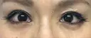 二重切開 / 眼瞼下垂（切開） / タレ目形成・グラマラスライン（切開） 湘南美容クリニック 辻堂アカデミア DAY 17 サムネイル用