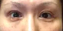 二重切開 / 眼瞼下垂（切開） / タレ目形成・グラマラスライン（切開） 湘南美容クリニック 辻堂アカデミア DAY 23 サムネイル用