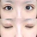 二重切開 / 上まぶたの脂肪取り TCB東京中央美容外科 江坂院 DAY 5 サムネイル用