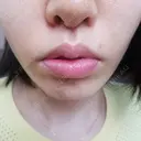 人中短縮 CLASSY 仙台美容外科・美容皮膚科 AFTER サムネイル用