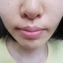 人中短縮 CLASSY 仙台美容外科・美容皮膚科 DAY 23 サムネイル用