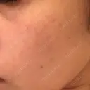 YAGレーザー 仁愛クリニック DAY 7 サムネイル用