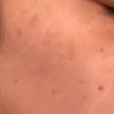 YAGレーザー 仁愛クリニック DAY 7 サムネイル用