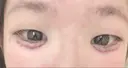 その他（目元） ばん皮膚科 DAY 0 サムネイル用