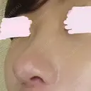 鼻尖形成（切開） / 小鼻縮小（切開） / 軟骨移植 / 骨切幅寄せ HANABI整形外科 DAY 124 サムネイル用