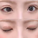 二重切開 / 上まぶたの脂肪取り TCB東京中央美容外科 江坂院 DAY 7 サムネイル用