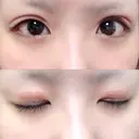 二重切開 / 上まぶたの脂肪取り TCB東京中央美容外科 江坂院 DAY 7 サムネイル用