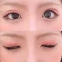 二重切開 / 上まぶたの脂肪取り TCB東京中央美容外科 江坂院 DAY 7 サムネイル用